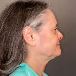 Facelift Before & After Patient #3617