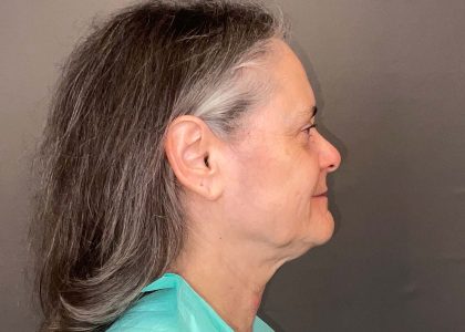 Facelift Before & After Patient #3617