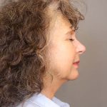 Facelift Before & After Patient #3225