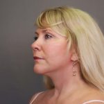 Facelift Before & After Patient #3224
