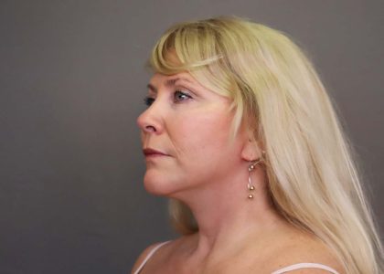 Facelift Before & After Patient #3224