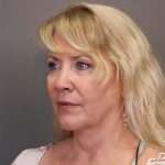 Facelift Before & After Patient #3224