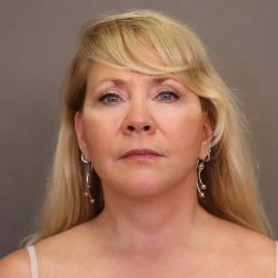 Facelift Before & After Patient #3224