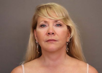 Facelift Before & After Patient #3224