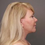 Facelift Before & After Patient #3224