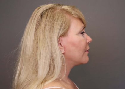 Facelift Before & After Patient #3224