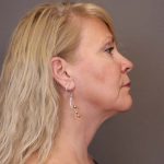 Facelift Before & After Patient #3224