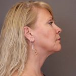 Facelift Before & After Patient #3224