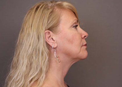Facelift Before & After Patient #3224