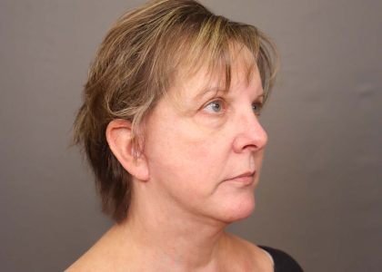 Facelift Before & After Patient #3222