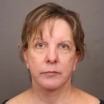 Facelift Before & After Patient #3222