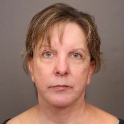 Facelift Before & After Patient #3222