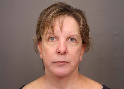 Facelift Before & After Patient #3222