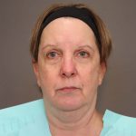 Facelift Before & After Patient #3222