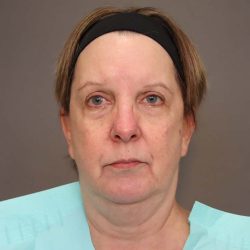 Facelift Before & After Patient #3222
