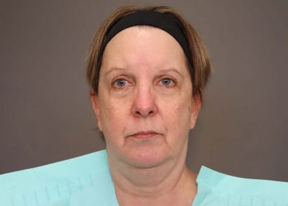 Facelift Before & After Patient #3222