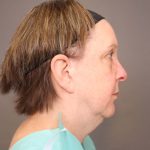 Facelift Before & After Patient #3222