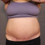 Abdominoplasty Before & After Patient #3176