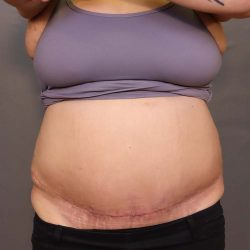 Abdominoplasty Before & After Patient #3176