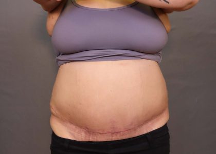 Abdominoplasty Before & After Patient #3176