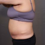 Abdominoplasty Before & After Patient #3176