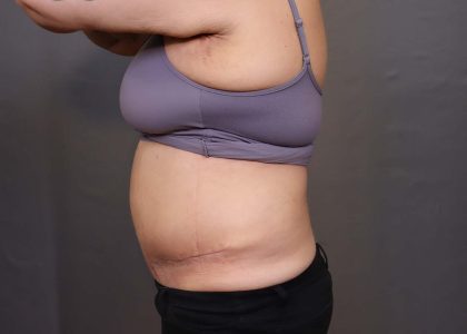 Abdominoplasty Before & After Patient #3176