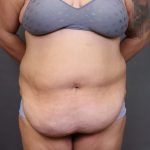 Abdominoplasty Before & After Patient #3176