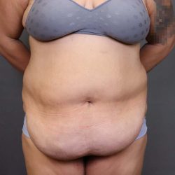 Abdominoplasty Before & After Patient #3176