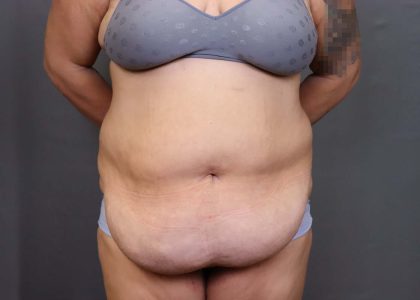 Abdominoplasty Before & After Patient #3176