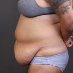 Abdominoplasty Before & After Patient #3176
