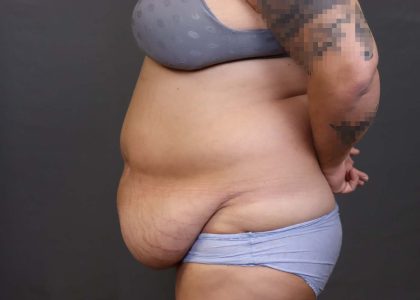 Abdominoplasty Before & After Patient #3176