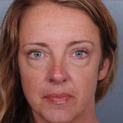 Blepharoplasty Before & After Patient #3588