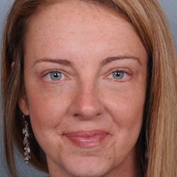 Blepharoplasty Before & After Patient #3588