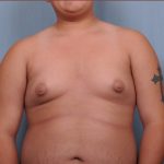 Male Breast Reduction Before & After Patient #4151