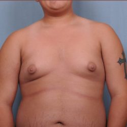 Male Breast Reduction Before & After Patient #4151