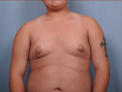 Male Breast Reduction Before & After Patient #4151