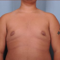 Male Breast Reduction Before & After Patient #4151