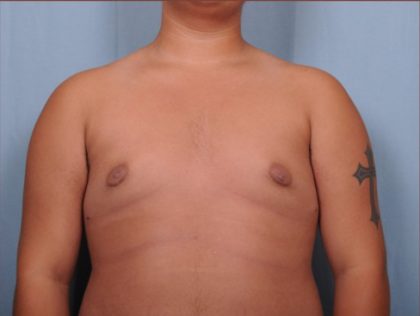 Male Breast Reduction Before & After Patient #4151