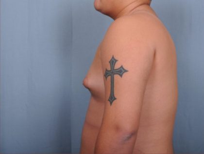 Male Breast Reduction Before & After Patient #4151