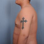 Male Breast Reduction Before & After Patient #4151