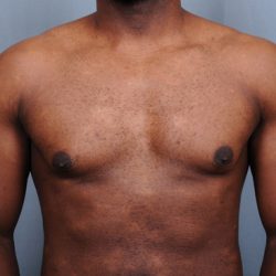 Male Breast Reduction Before & After Patient #4150