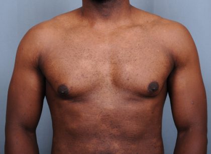 Male Breast Reduction Before & After Patient #4150