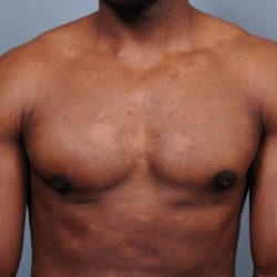 Male Breast Reduction Before & After Patient #4150