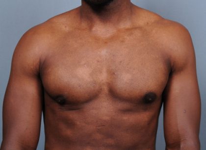 Male Breast Reduction Before & After Patient #4150