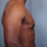 Male Breast Reduction Before & After Patient #4150