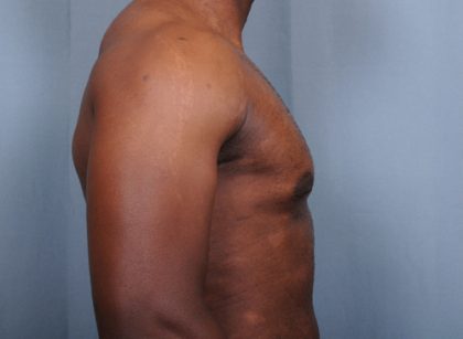 Male Breast Reduction Before & After Patient #4150