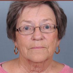 Neck Lift Before & After Patient #3698