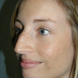 Rhinoplasty Before & After Patient #4447