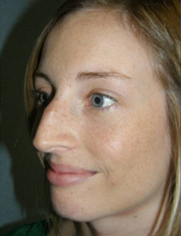 Rhinoplasty Before & After Patient #4447