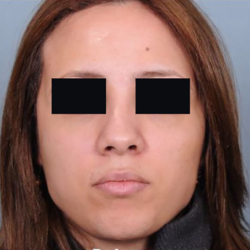Rhinoplasty Before & After Patient #4446